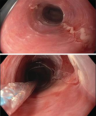 Case Report: Eosinophilic Esophagitis in a Patient With a Novel STAT1 Gain-of-Function Pathogenic Variant